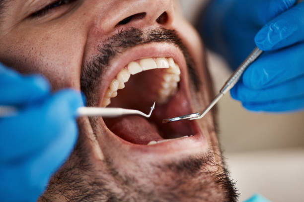 Best Emergency Wisdom Teeth Removal in Independence, KS
